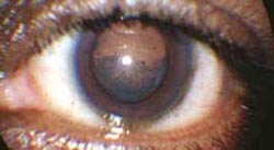 cataract 3