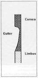 Corneal gutter