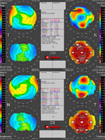 Orbscan maps