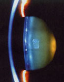 slit view of lens